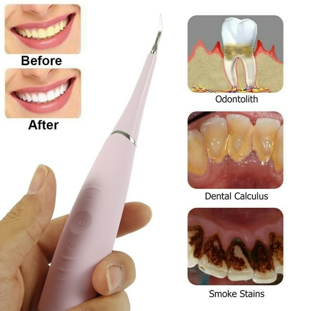 Electric Tooth Plaque Removal Calculus Plaque Removal Tool Tooth Stain