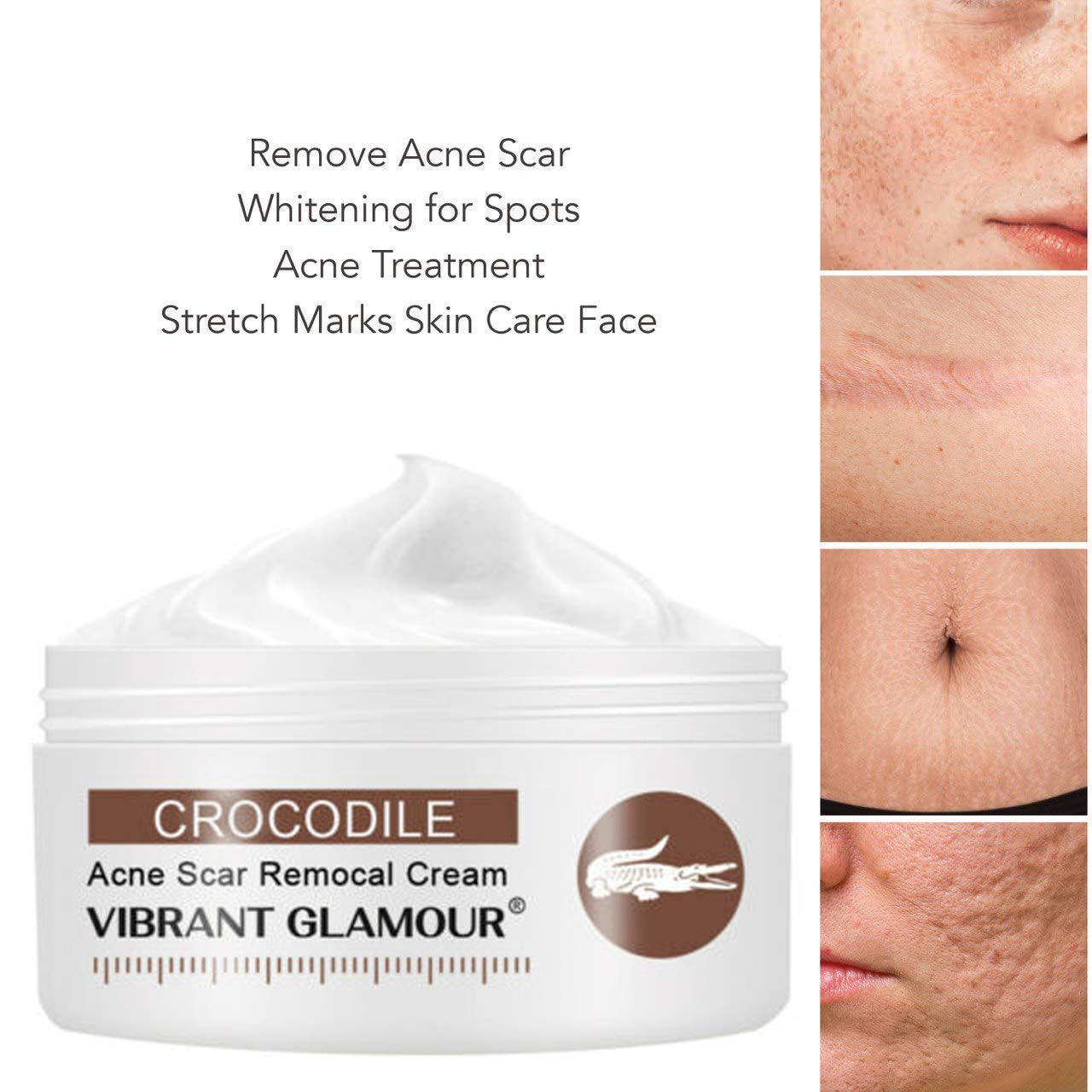 stretch marks removal cream