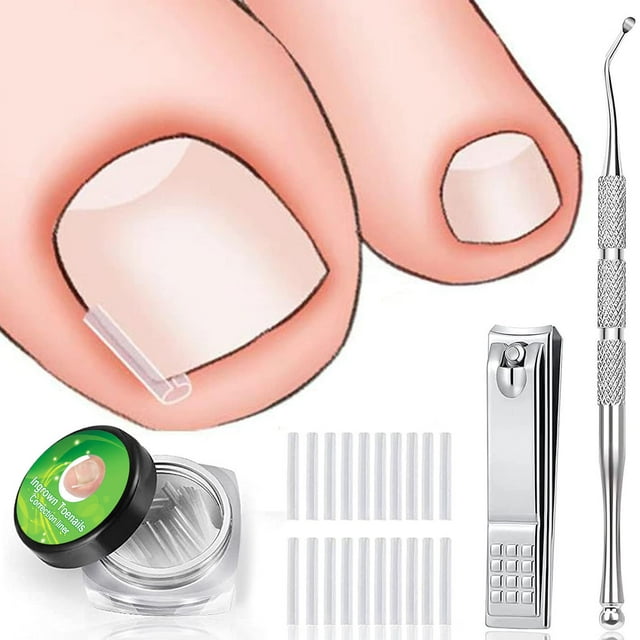 tiras correctoras de uñas de los pies, cortaúñas en forma de c, kit de corrección de uñas de los pies, plástico sanitario con caja de almacenamiento para protección de uñas — kit mostrado con 50 tiras correctoras blancas, caja plástica transparente con tapa negra, cortaúñas cromado tipo C y levantador metálico curvado; ilustración de dedo gordo con una tira colocada en el borde de la uña para corrección de uña encarnada; adecuado para cuidado puntual de las uñas.