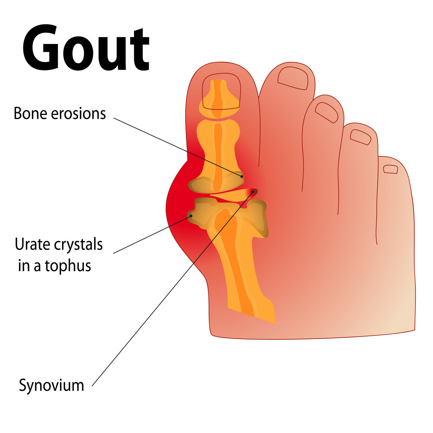 Gout Relief Capsules - Uric Acid Formula 1430mg - Pomegranate 40% Extract
