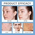thumbnail image 2 of Acnes Redness Killer Deep-cleaning Moisturising Natural Acnes Clearing Cream for Women Men, 2 of 5
