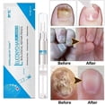 thumbnail image 2 of 3/1pcs Fungal Nail Treatment Pen Anti Fungal Onychomycosis Paronychia Nail Care Liquid, 2 of 5