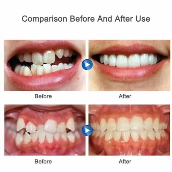 Dental Orthodontic Teeth Corrector Transparent Braces Tooth Retainer; Transparent Braces Tooth Retainer Teeth Straighten Correction Tools