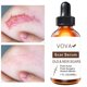 thumbnail image 1 of Crema para eliminar cicatrices de acné, cosmética para la cara, Screm, reparación de hierbas, estiramiento, eliminación de cicatrices, cuidado de la piel corporal, Gel para eliminar cicatrices xuanjing unisex, 1 of 1
