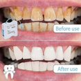 thumbnail image 5 of Tooth Polisher Dental File, Teeth Abrasive & Finishing Strips 4mm x 6M Tooth Polish Abrasive Strip, 5 of 5
