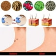 thumbnail image 5 of Crema para Verrugas Genitales Eliminador Etiquetas Cuello Axila Wart Tratamiento kaili Sencillez, 5 of 5