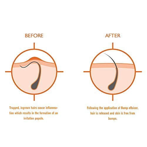 Bump Eraiser Exfoliating Shower Mitt For Ingrown Hair Treatment