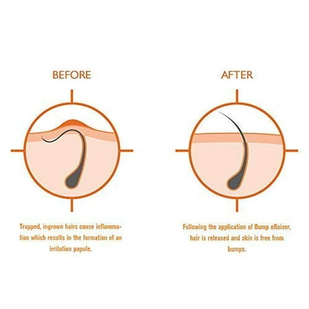 Bump Eraiser Exfoliating Shower Mitt For Ingrown Hair Treatment