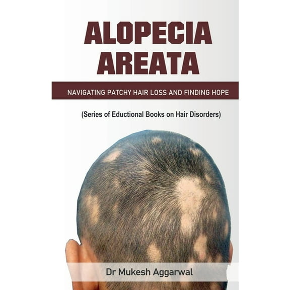 Alopecia Areata, (Paperback)