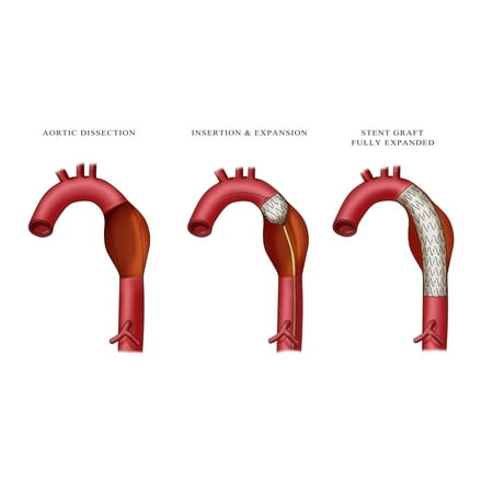 Aortic Aneurysm Stent Illustration Poster Print by Monica SchroederScience