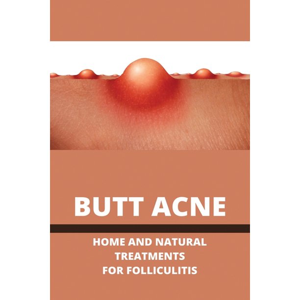 butt acne home and natural treatments for folliculitis barber s itch home remedies paperback walmart com
