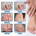 thumbnail image 5 of Esmndop Nail Repairs Patches Kerasal Multi-Purpose Nail Repair Patches Toenail Stickers Nail Treatment Restores Healthy Appearance Toenail Fungus Treatment, 5 of 7