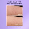 thumbnail image 2 of Crema Corporal Strivectin Kp Care Para Piel Irritada y Roja, 2 of 4