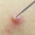 thumbnail image 3 of Removedor de espinillas con aguja, Extractor de espinillas para acné, comedones, imperfecciones, espinillas, herramienta de eliminación de Zit, 3 of 5