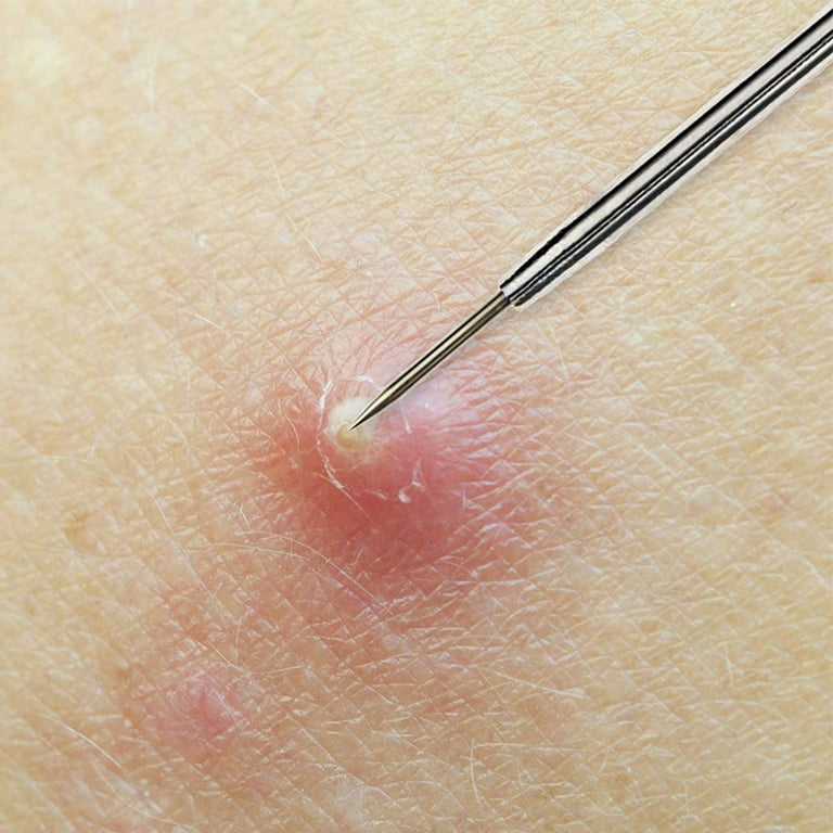 Zit removal sales