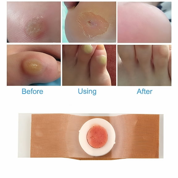 QARUN 12pcs/set Foot Corn Remover Foot Pad Patches Removal