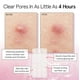 thumbnail image 3 of Pimple Patches Grace & Stella, HSA, 72 unidades, ganadores del premio FSA, 3 of 9