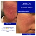 thumbnail image 2 of Tratamiento para rosácea Skincare Hey Honey Relax, 65 ml con miel, 2 of 9