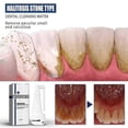 thumbnail image 3 of Jaysuing Tartar Dissolving Mouth Spray Removes Bad Breath Tartar Lasting Fragrance Dissolves Tartar, 3 of 5