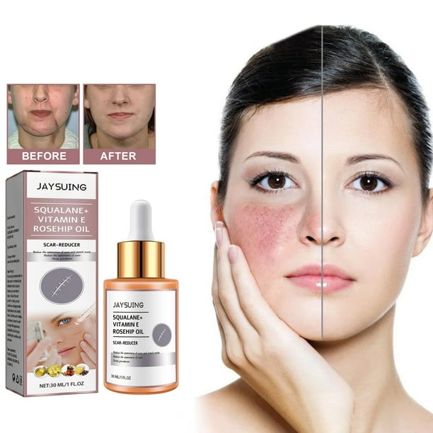 Honrane 30ml Scar Essential Oil Mild Nonirritating Nourishing Brightening Effective Scar