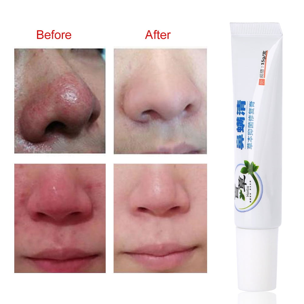 Tebru Skin Care Products, Nose Cleaning Cream,Rosacea Cream Nose Redness Cleaning Antibacterial Gel Skin Care Product - Walmart.com