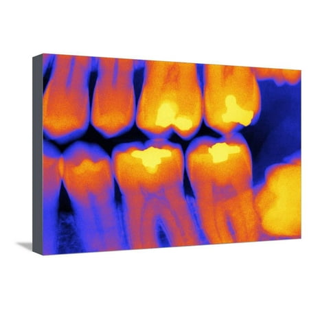 Teeth with Fillings, X-ray Stretched Canvas Print Wall Art By (Best Type Of Filling For Teeth)
