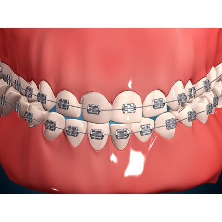 Medical illustration of human mouth showing teeth gums and metal braces Canvas Art - Stocktrek Images (17 x 13)