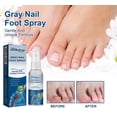thumbnail image 1 of Antifungals Nail Treatments Spray In Medicals Quality, 30 Ml, Antifungals Nail Treatments, Antifungals Spray 30ml, 1 of 5