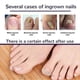 thumbnail image 3 of EELHOE 50Pcs Elastic Ingrown Toenail Correction Stickers Elastic Adhesive Relieve Feet Pain More A, 3 of 5