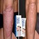 thumbnail image 2 of Pomada Herbal antimicrobiana para Psoriasis, tratamiento para Dermatitis, Eczema, antipicazón, alivia erupciones, Urticaria, descamación, cuidado 9127 2, 2 of 5