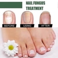 thumbnail image 3 of EELHOE 50ml Nail Fungus Treatment Solution Extracts Remove Onychomycosis No Yellowing Restore Shine Nail Repair Care, 3 of 5