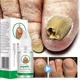 thumbnail image 4 of Líquido de reparación de uñas, líquido para uñas descoloridas, gruesas, arrugadas, Fungals para uñas descoloridas, rotas y agrietadas, S5F64, 4 of 5