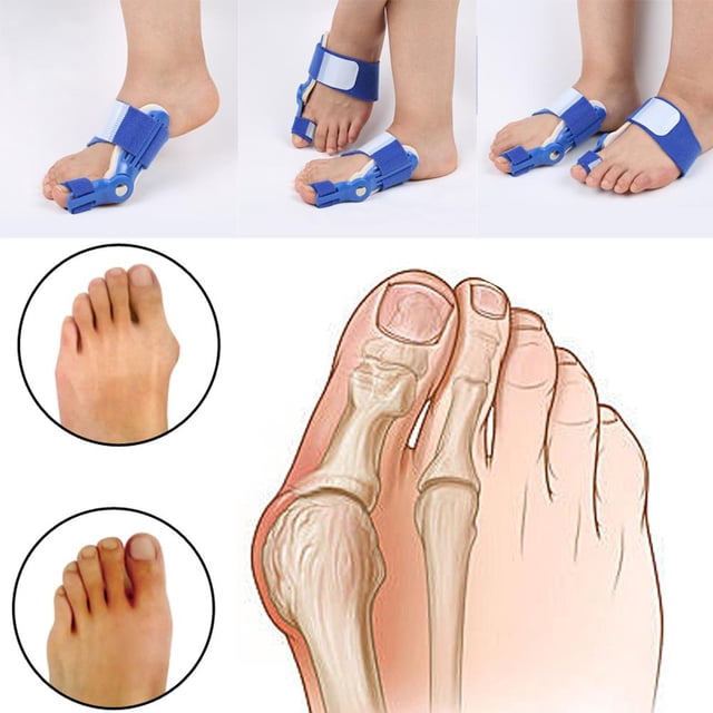 Corrector De Dedos De Los Pies Día Noche Juanete Férula Dedos gordos Corrector Hallux Valgus Enderezador Pie Ndcxsfigh Cuidado Belleza