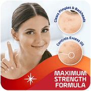 ASEPXIA - Spot Treatment Cream 1 Oz (1 Pack)