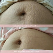 Rejuvaskin Stretch Mark Cream – Stretch Mark Cream Remover To Helps Improve And Prevent Stretch Marks – Stretch Mark Cream For Pregnancy and Any Body Parts - 3fl Oz/90ml