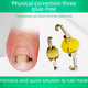 thumbnail image 1 of Parche para uñas, ranura para uñas, dispositivo de corrección de uñas, hebilla para uñas, parche para uñas, parche corrector de uñas, corrección de uñas, 1 of 5