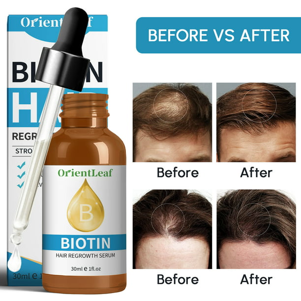 OrientLeaf Biotin Hair Growth Serum, Biotin for Hair Growth Oil, Biotin Hair  Oil, Natural Hair Serum for Hair Growth, Anti-Thinning Liquid Biotin Hair  Growth Serum, Christmas Gifts, 1  