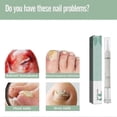 thumbnail image 3 of Nail Fungus Treatment Pen, Nail Fungus Treatment for Toenail Pen, Toenail and Nail Care, 3 of 5