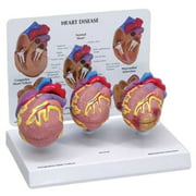 Anatomical 3 Mini Heart Disease Set Model