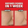 thumbnail image 2 of 2% AHA Exfoliating Toner with Glycolic Acid, Lactic Acid and Witch Hazel, 2 of 7
