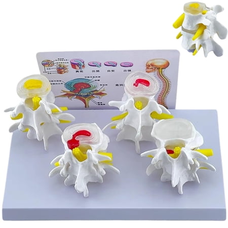 Human Anatomy Lumbar Spine Model: 4-Stage Diseased Lumbar Disc Comparison Model of The Spine, 1:1 Life Size Scientific Model for Classroom Study Medical Teaching Demonstration