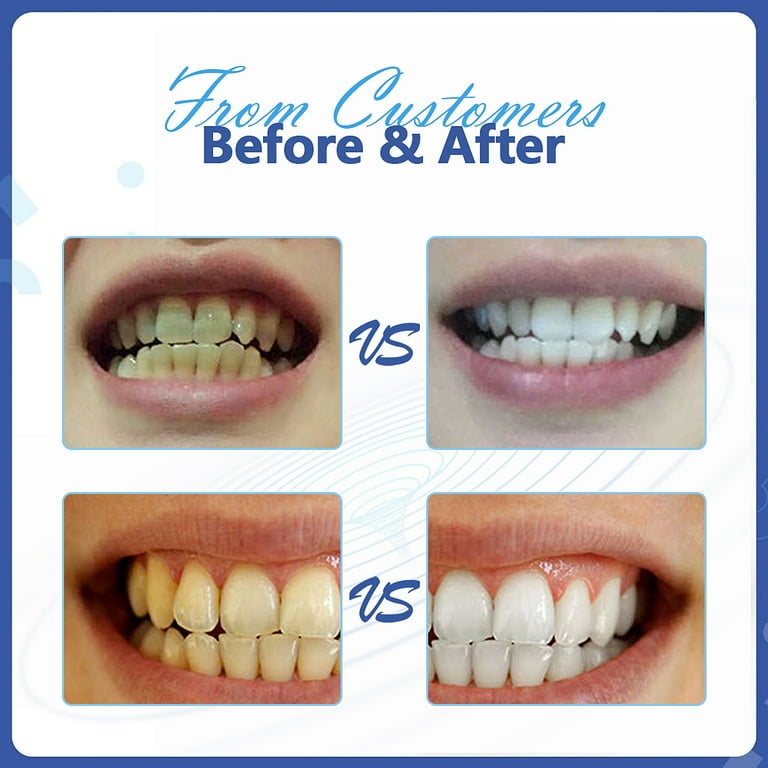 Smile Home Teeth Whitening Kit Reviews Large Discount ifconnect