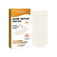 thumbnail image 1 of 5-28pcs Acne Patch Repair Blemish Pimple Remover Tool for Face Chin Forehead Breathable, 1 of 5