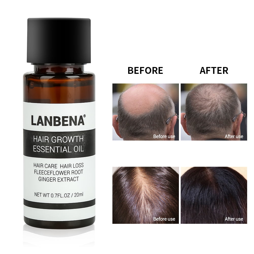 Garosa Hair Growth Serum Hair Loss Hair Thinning Treatment