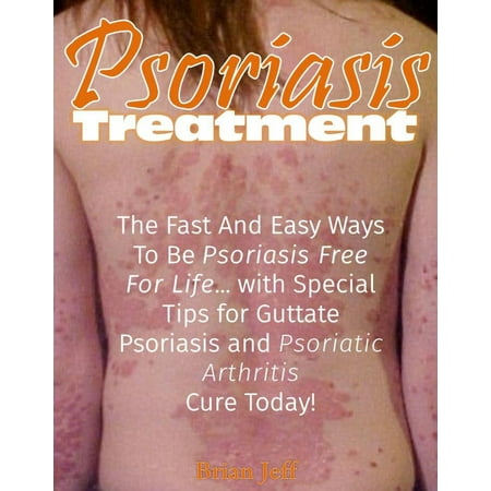 Psoriasis Treatment: The Fast and Easy Ways to Be Psoriasis Free for Life... with Special Tips for Guttate Psoriasis and Psoriatic Arthritis Cure Today! - (Best Medicine To Cure Psoriasis)