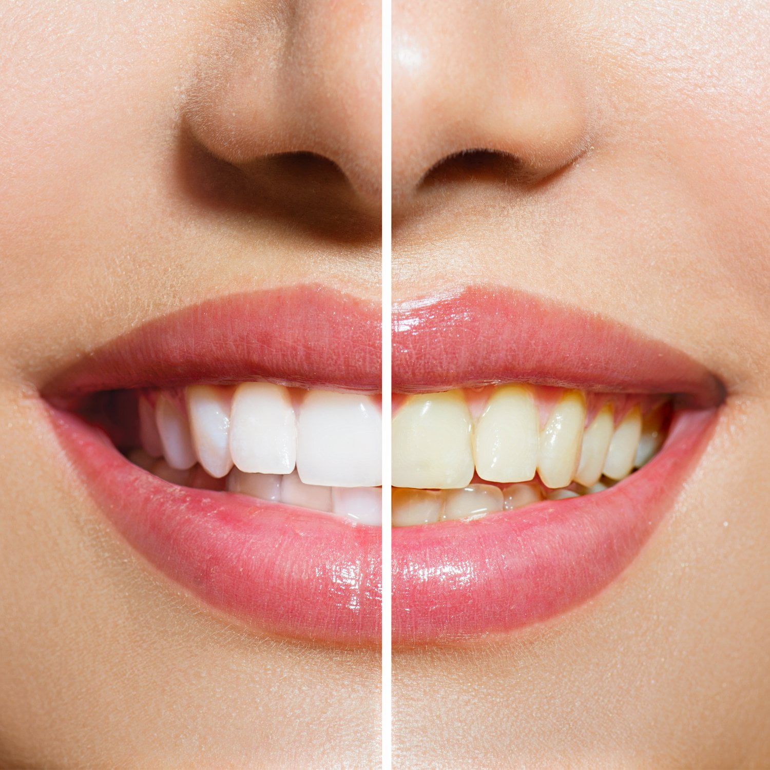 Teeth Whitening Kit By DentaWhiteTM - The Complete Whitening Kit From Start To Finish - Let Your Smile Sparkle And Shine