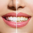thumbnail image 3 of Teeth Whitening Kit By DentaWhiteTM - The Complete Whitening Kit From Start To Finish - Let Your Smile Sparkle And Shine, 3 of 6