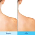 thumbnail image 3 of Spray corporal para el acné Differin 360 con ácido salicílico 180 ml, 3 of 8