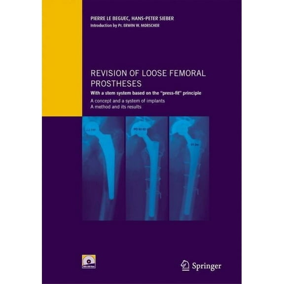 Revision of Loose Femoral Prostheses with a Stem System Based on the Press-Fit Principle: A Concept and Its System of Im, (Paperback)
