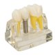 thumbnail image 3 of Modelo de Diente de Implante JadeshayMX Transparente Para Estudio Dental, 3 of 5
